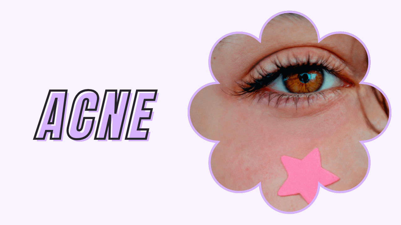 website banner titled acne with a photo of a woman with a pimple patch